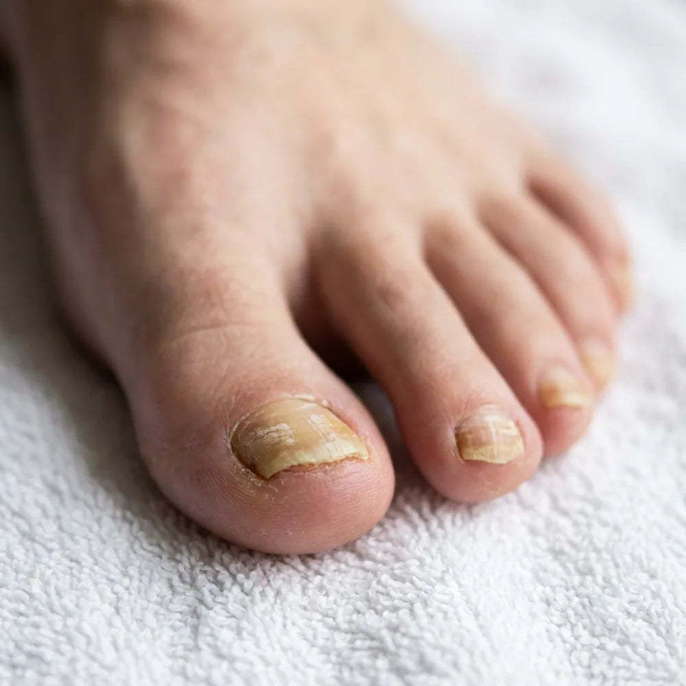 🦶 Bolígrafo Antifúngico para Uñas de los Pies — Ácido Undecilénico 25% · 4 ml