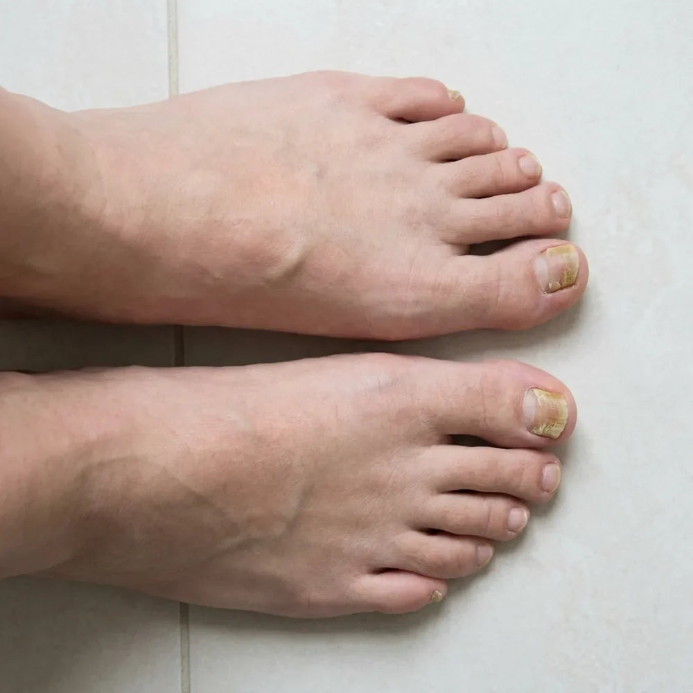 🦶 Bolígrafo Antifúngico para Uñas de los Pies — Ácido Undecilénico 25% · 4 ml